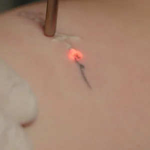 Tattoo and permanent make-up removal with Fotona StarWalker®