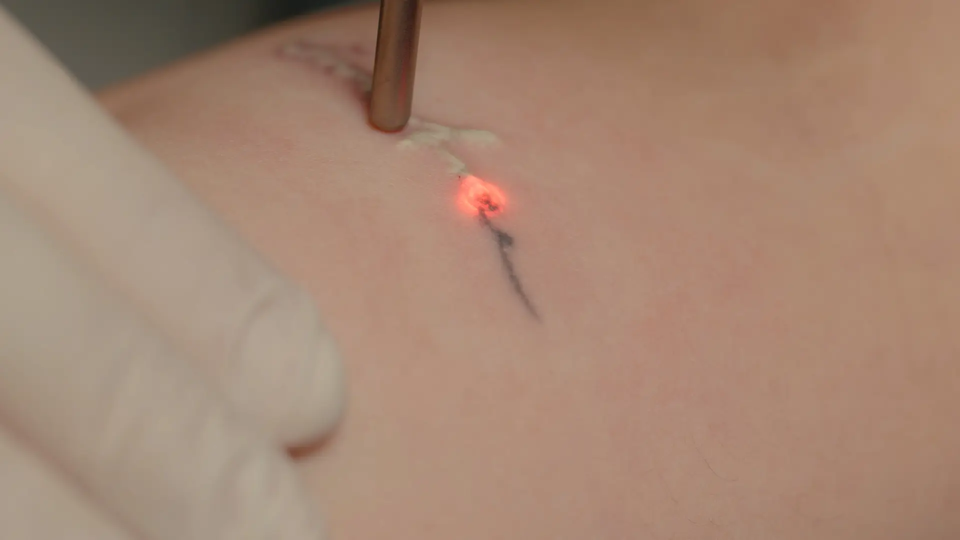 Tetovējumu un permanentā grima noņemšana ar Fotona StarWalker®