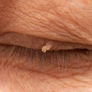 Wart Removal